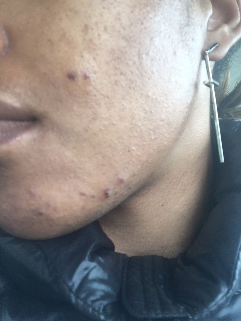 Hormonal acne 
