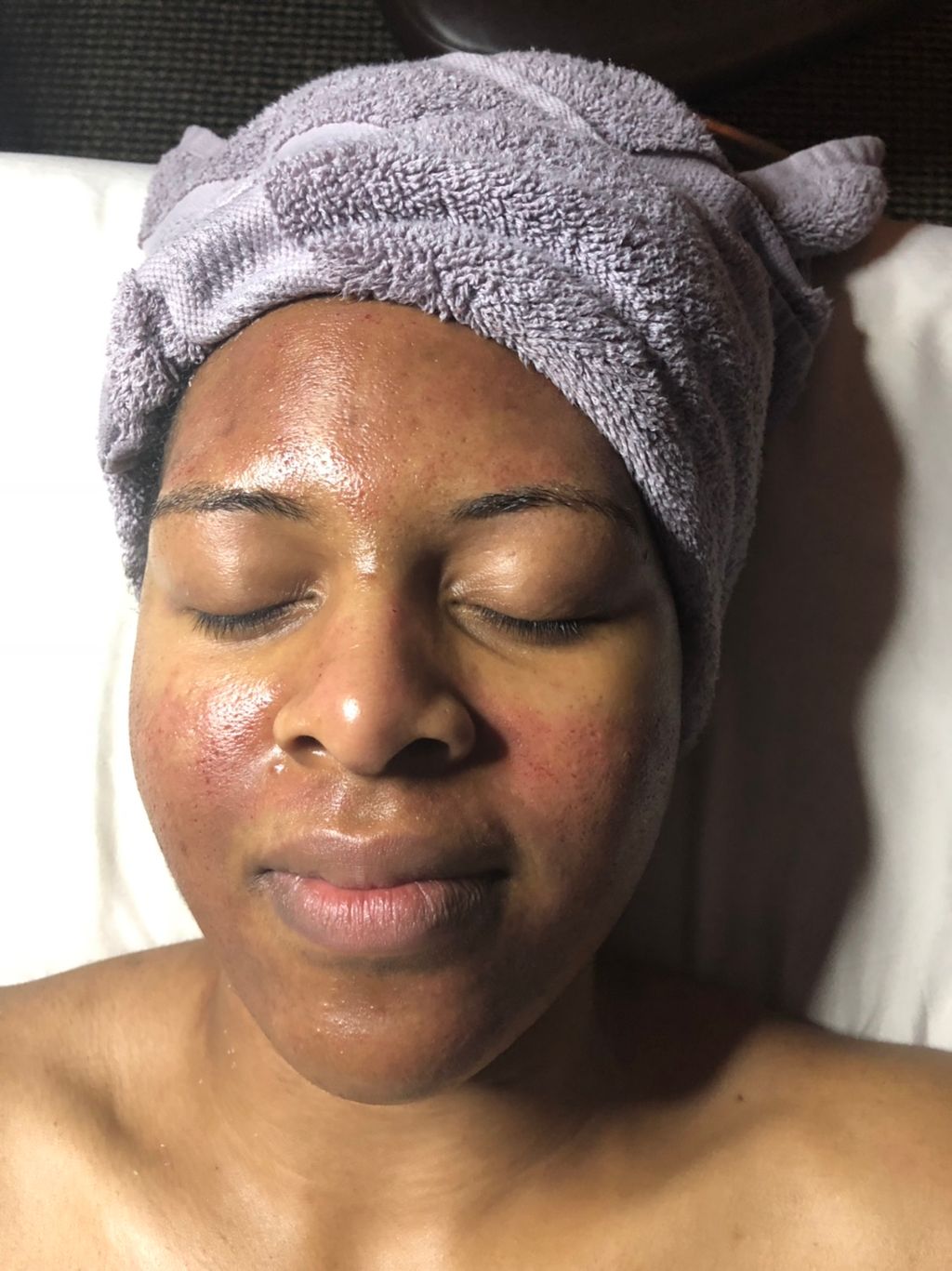 Microneedling 