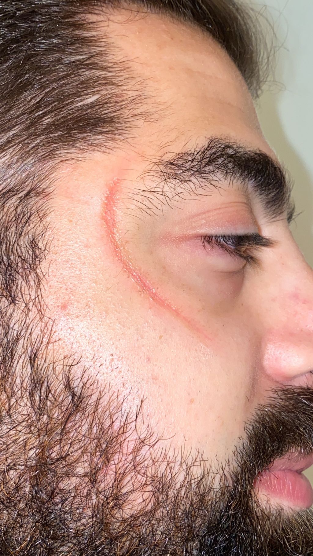 Scar injury with sfx