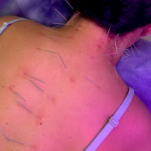 Acupuncture for neck and back pain.