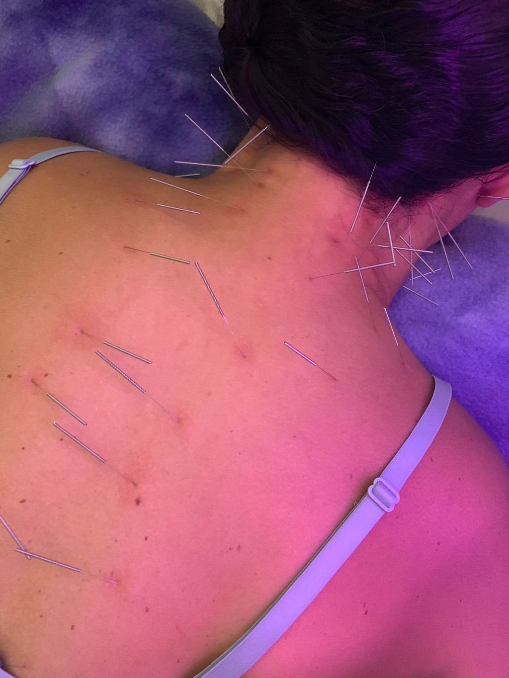 Acupuncture for neck and back pain.
