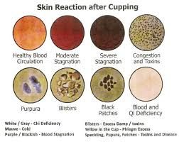 Skin Reaction after Cupping