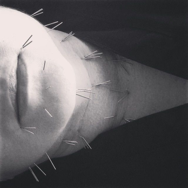 Anti-aging acupuncture is a great alternative to B