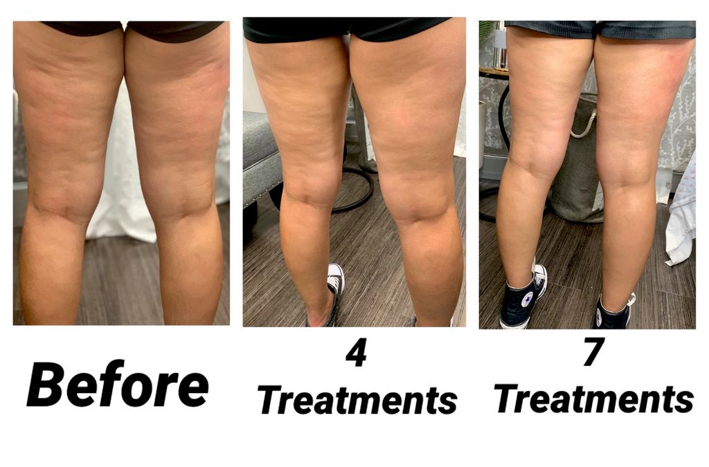 Cellulite treatment 