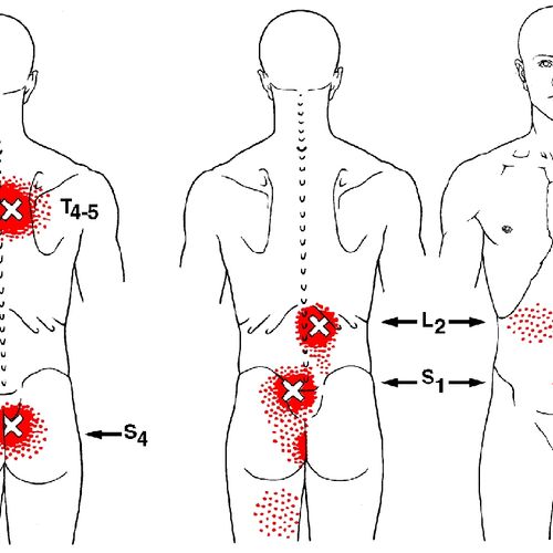Four possible back trigger points marked with thei