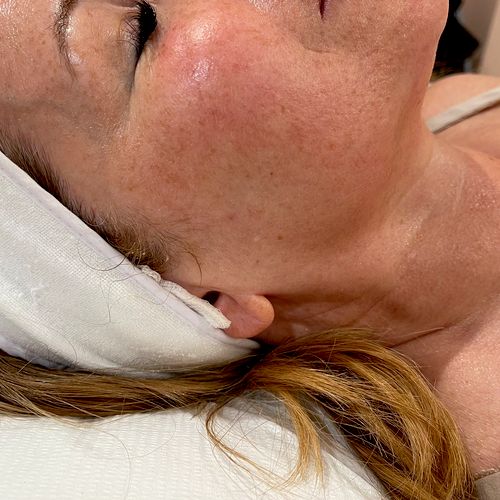 Post jet peel. Jaw like tighter and neck with lift