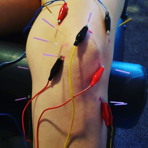 Electro Dry Needling for a client with runners kne