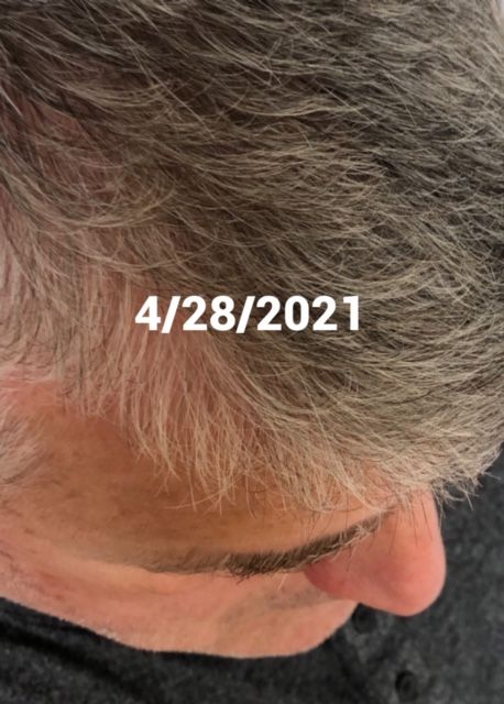 After (regrowing and soft)