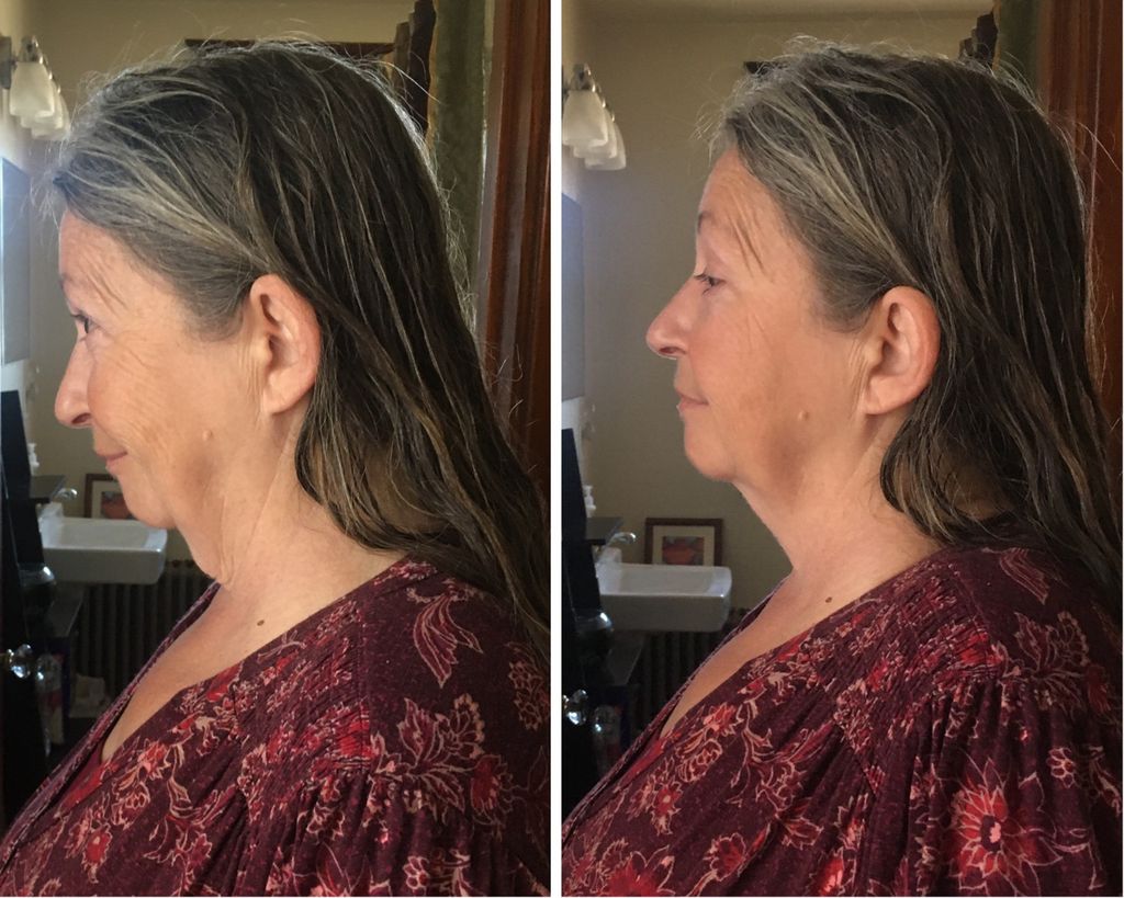 Posture Improvement (before & after)