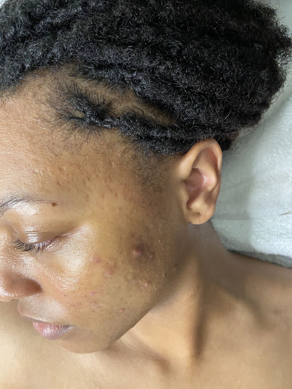 Acne and scarring. 