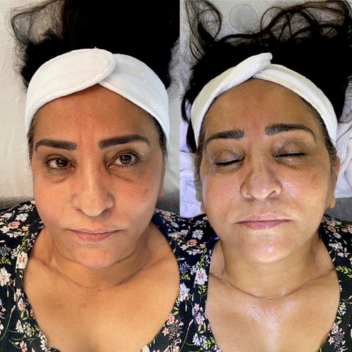 Before (left) & After (right) of the Anti Aging Facial, and extractions