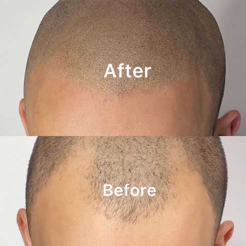 I did the SMP Scalp Micropigmentation treatment wi