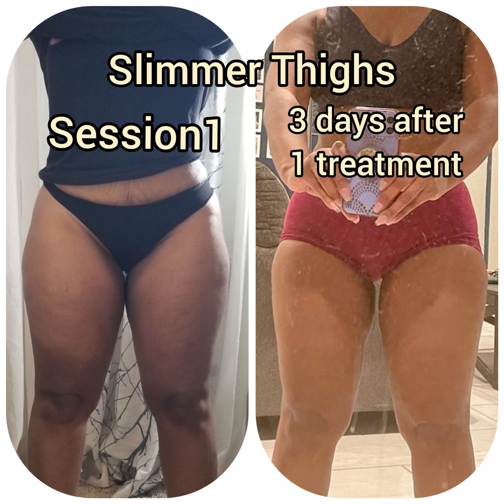 Laser Lipo + Cellulite Vacuum + Skin Tightening