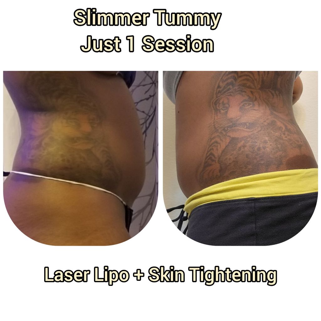 Laser Lipo + Skin Tightening