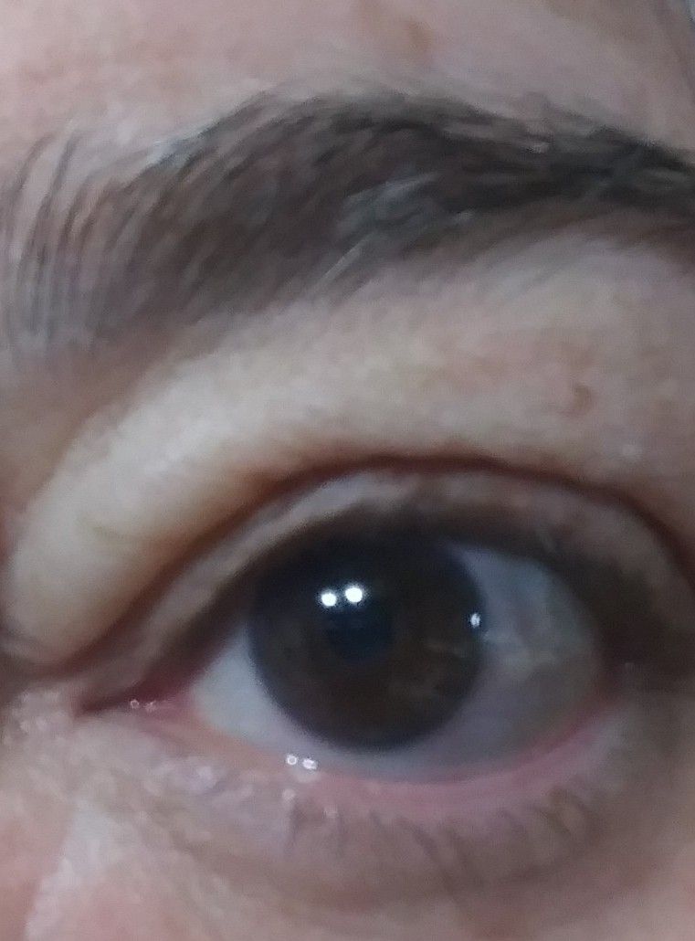 My swollen eye after cleaning KW shower it is encl