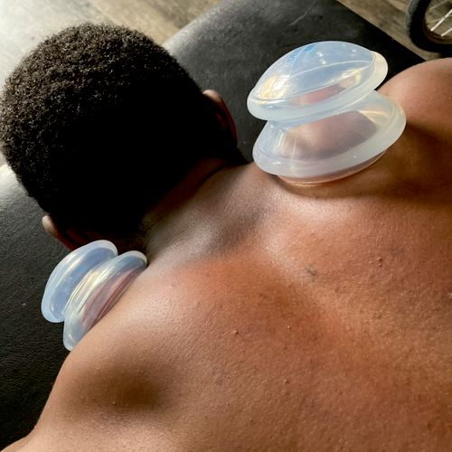 cupping!