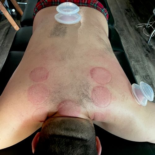 cupping!
