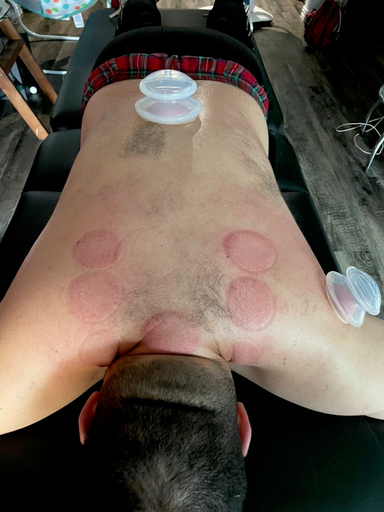 cupping!