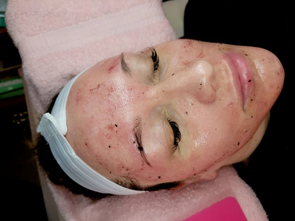 Enzymes Peel-Advanced Facials
