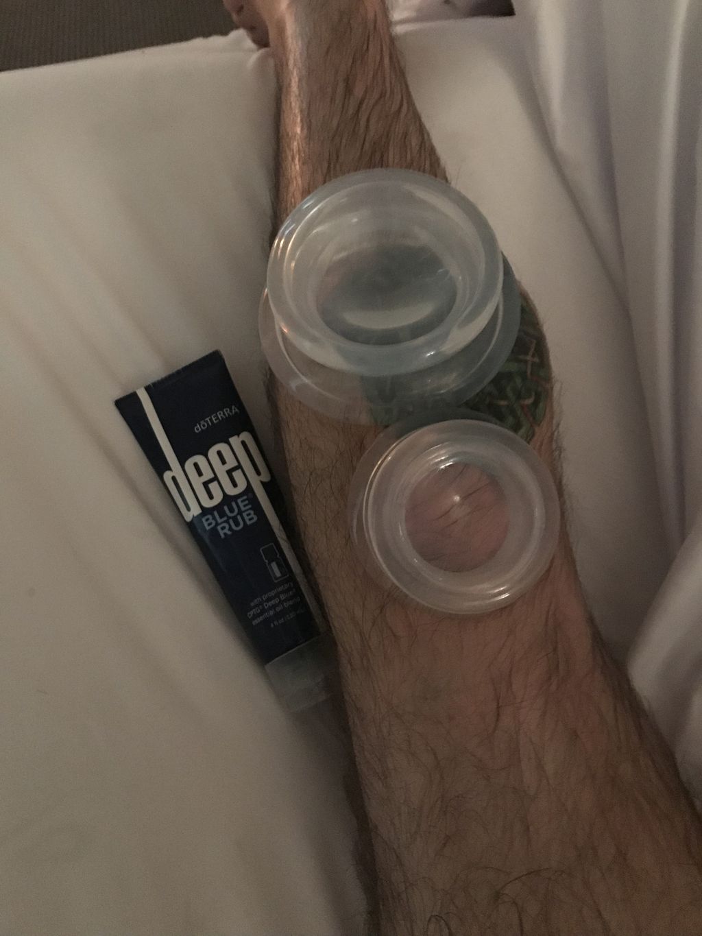 Cupping Therapy 