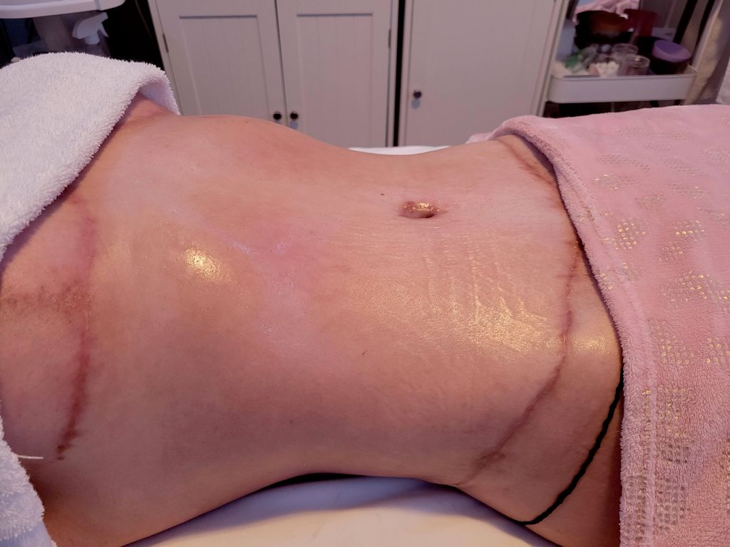 post surgery linfhatic drainage 