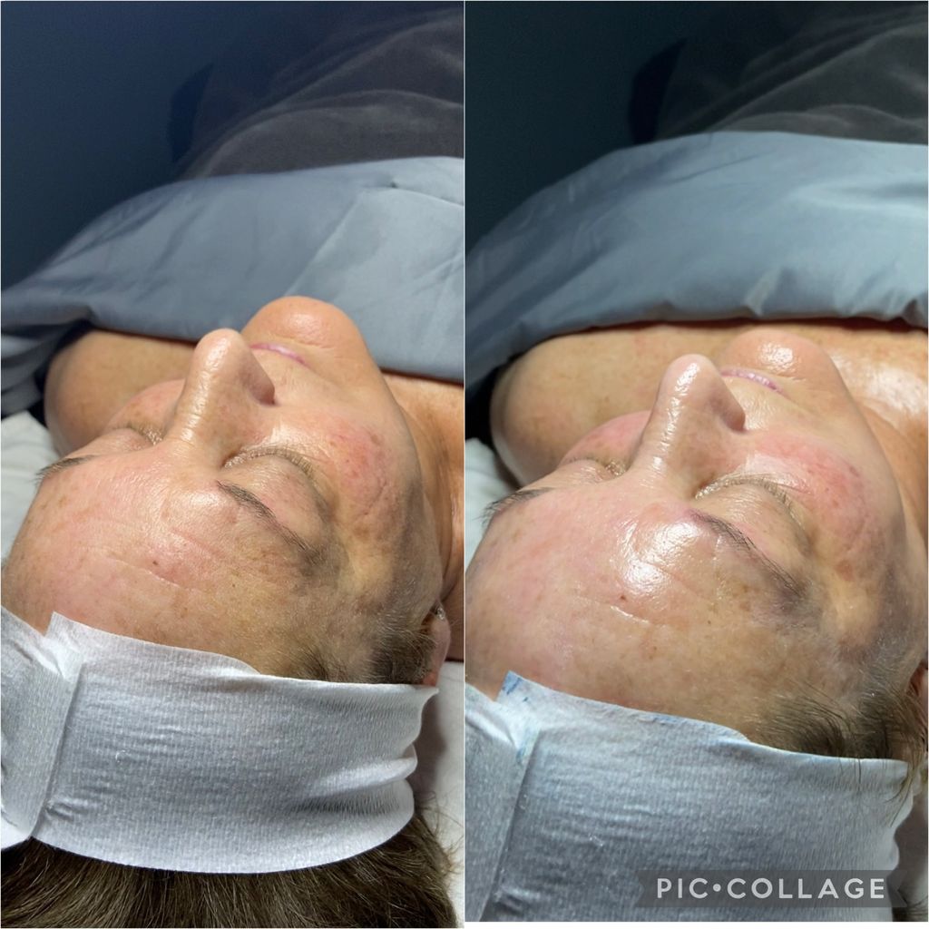 Tighten facial 