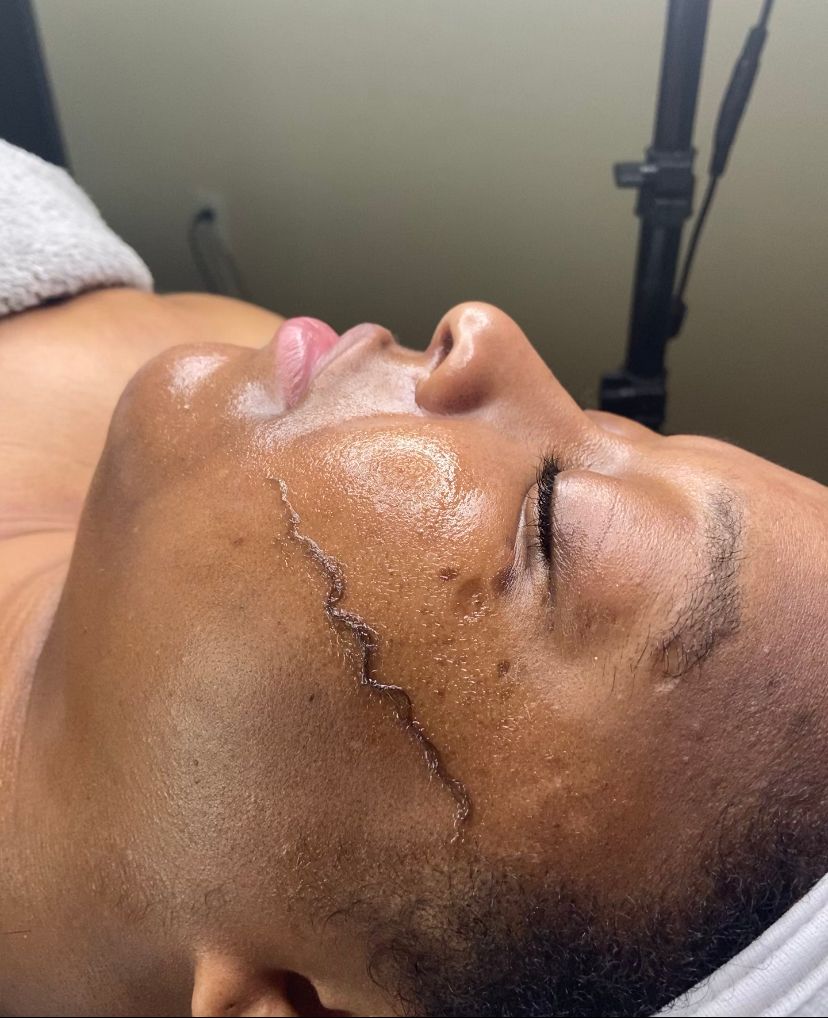 Dermaplane facial 