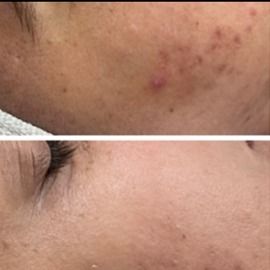 3 Microneedling Facial 