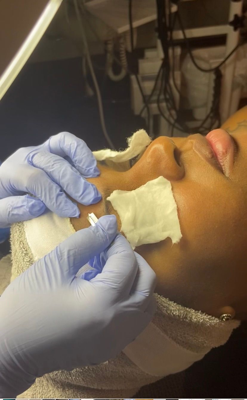 Extractions clear a clogged or compacted pore