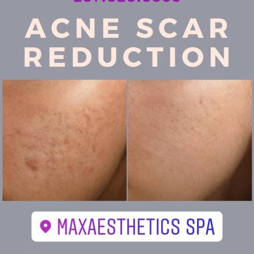Acne Scars Reduction Laser Treatment 