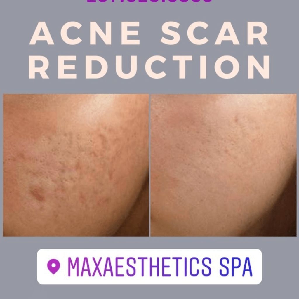 Acne Scars Reduction Laser Treatment 