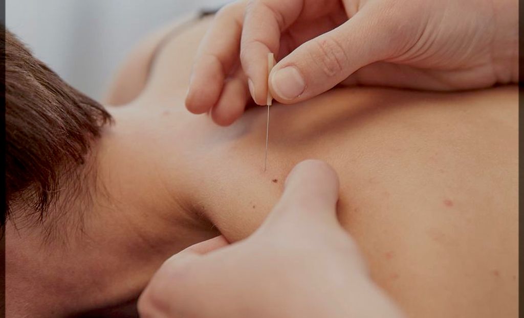 Dry needling for let upper trap