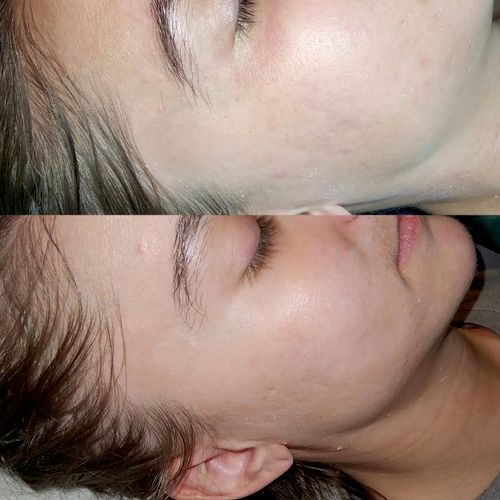 top before | bottom after (3 treatments + Glymed P