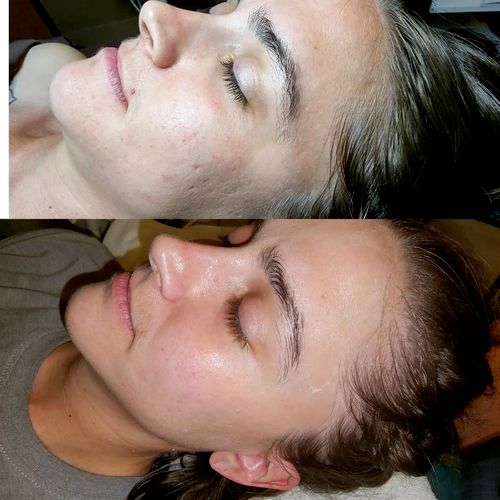 top before | bottom after - targeting acne / acne 