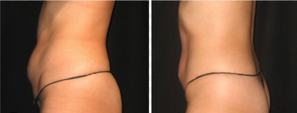 Tummy Sculpt