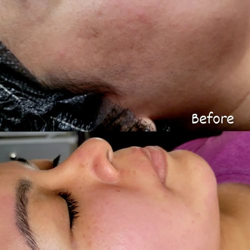 before and after Decogesting Facial and Dermaplane