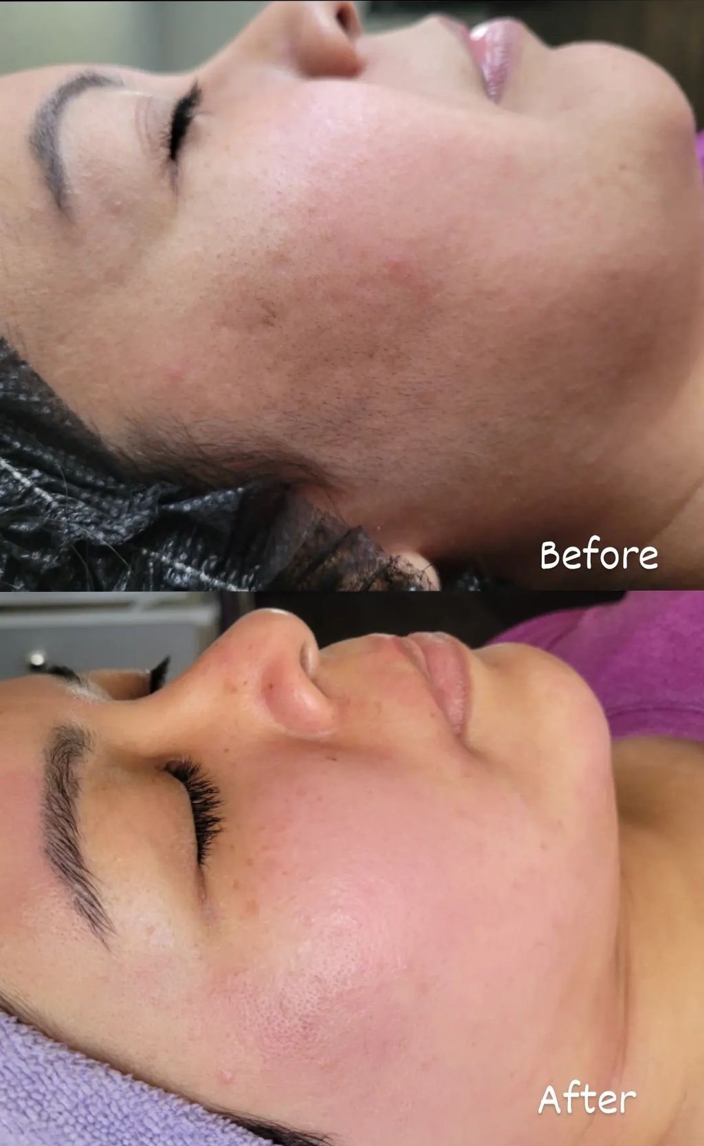 before and after Decogesting Facial and Dermaplane