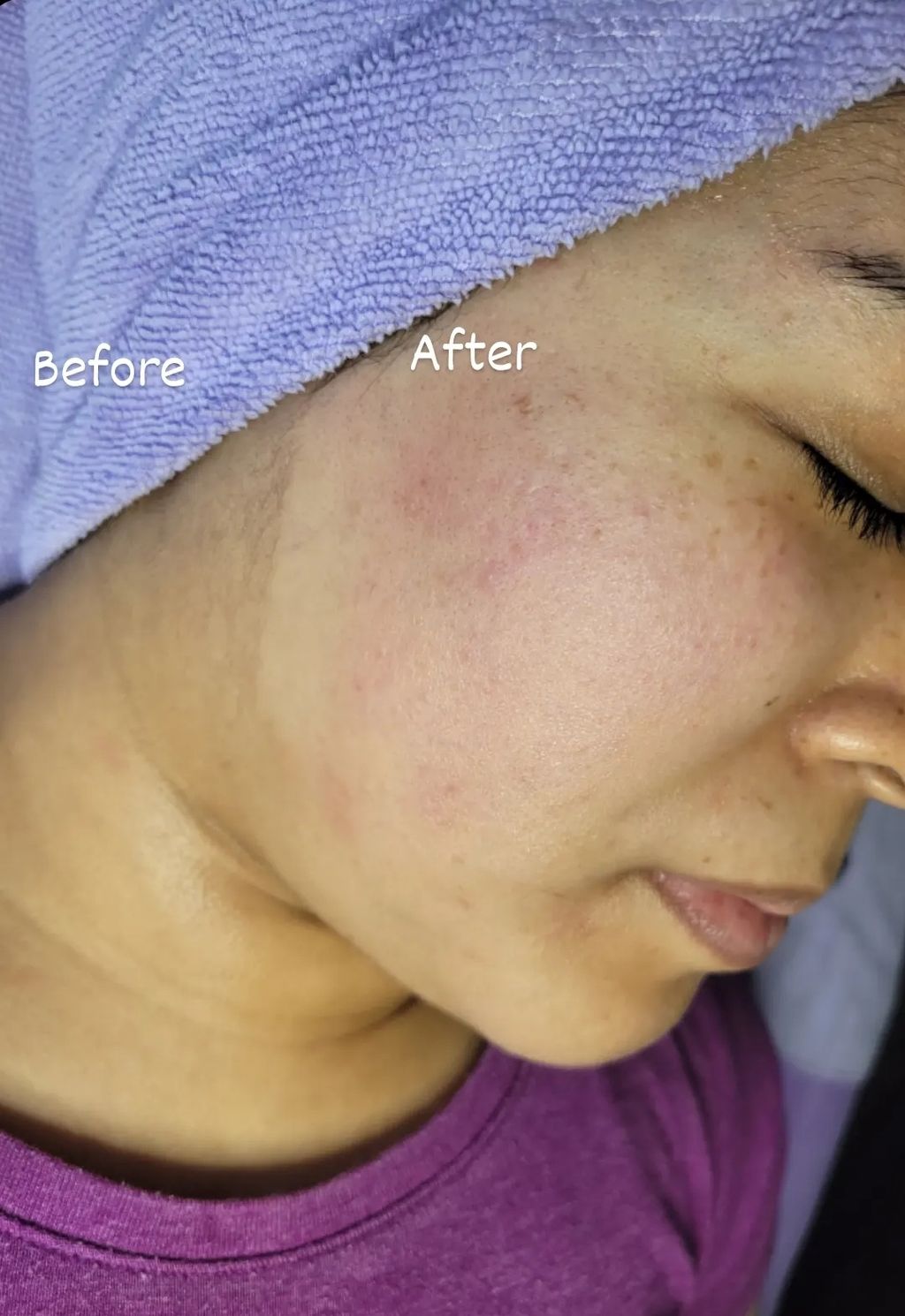 before and after Decogesting Facial and Dermaplane