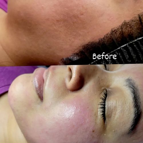 before and after Decogesting Facial and Dermaplane