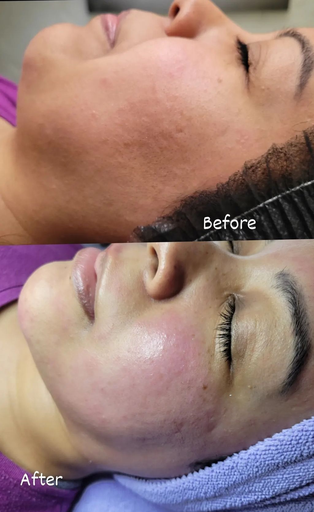 before and after Decogesting Facial and Dermaplane