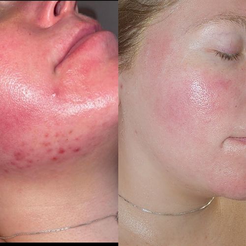 before | After- 6 months of working on redness and