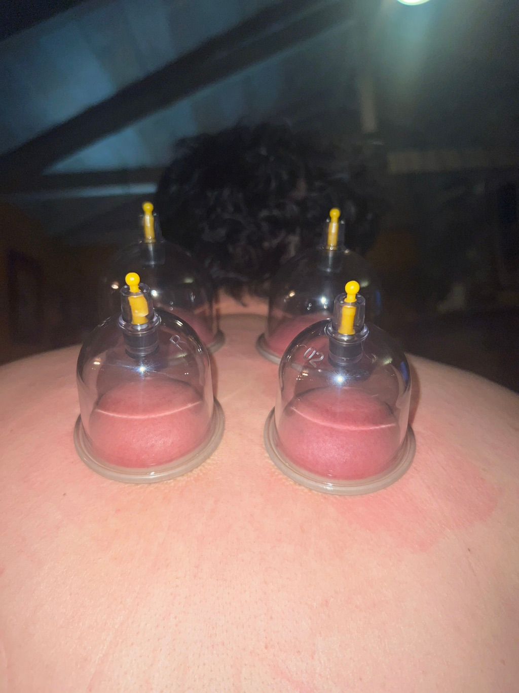 Cupping 