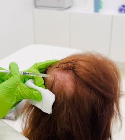 Helping with your hair loss.