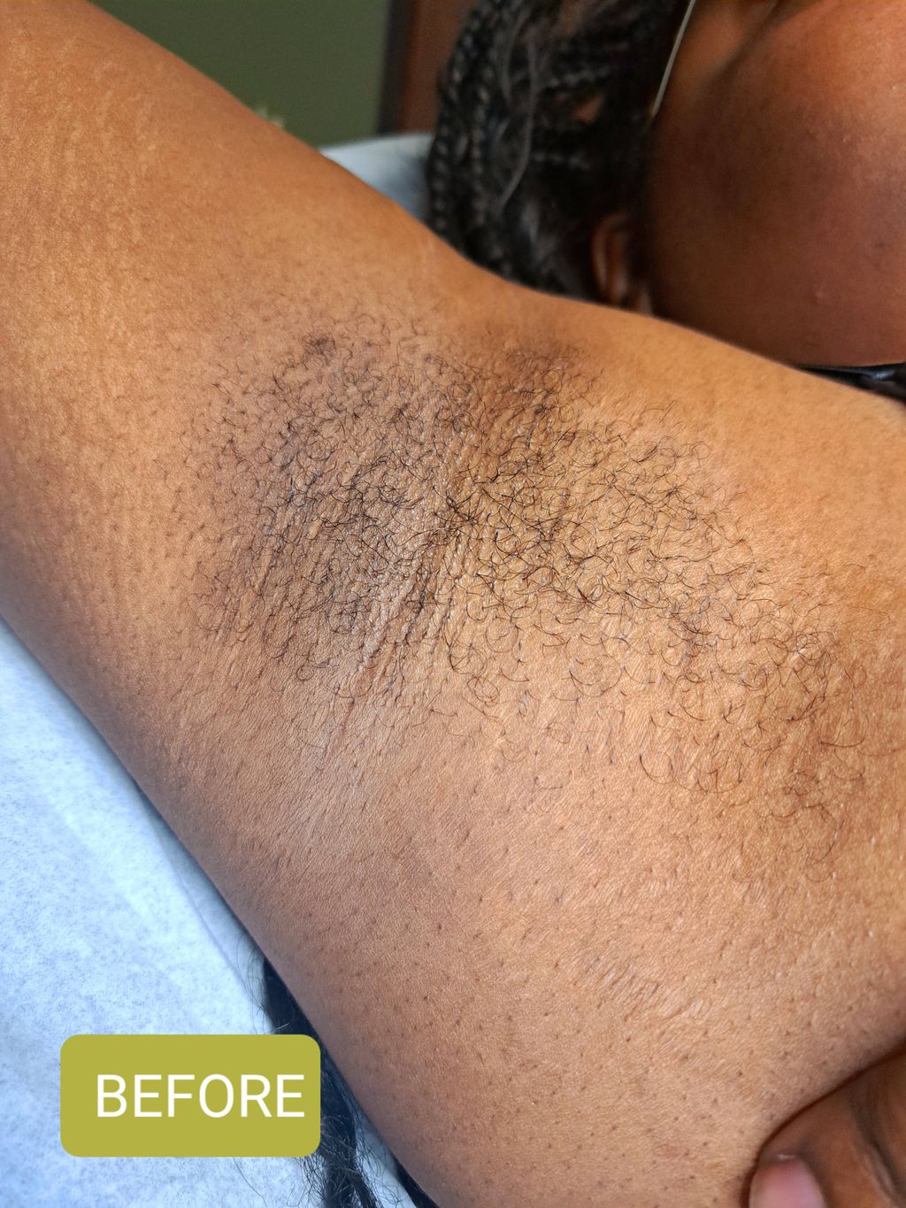 BEFORE Under Arm Wax