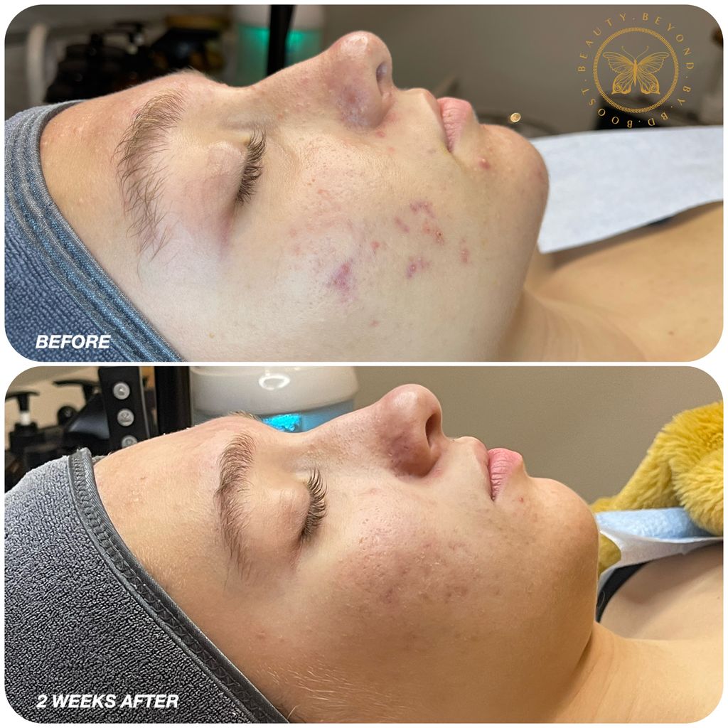 Acne Treatment 