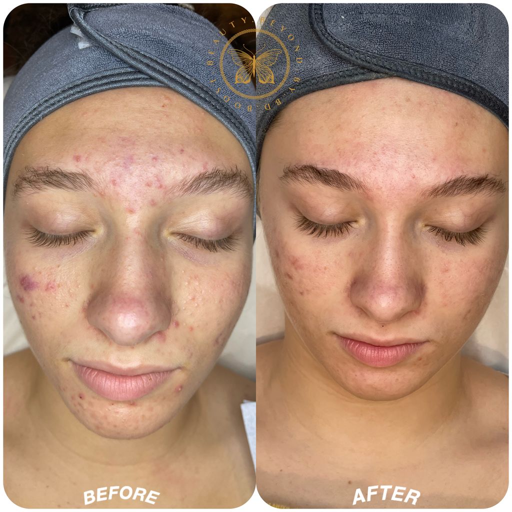 Acne Treatment 