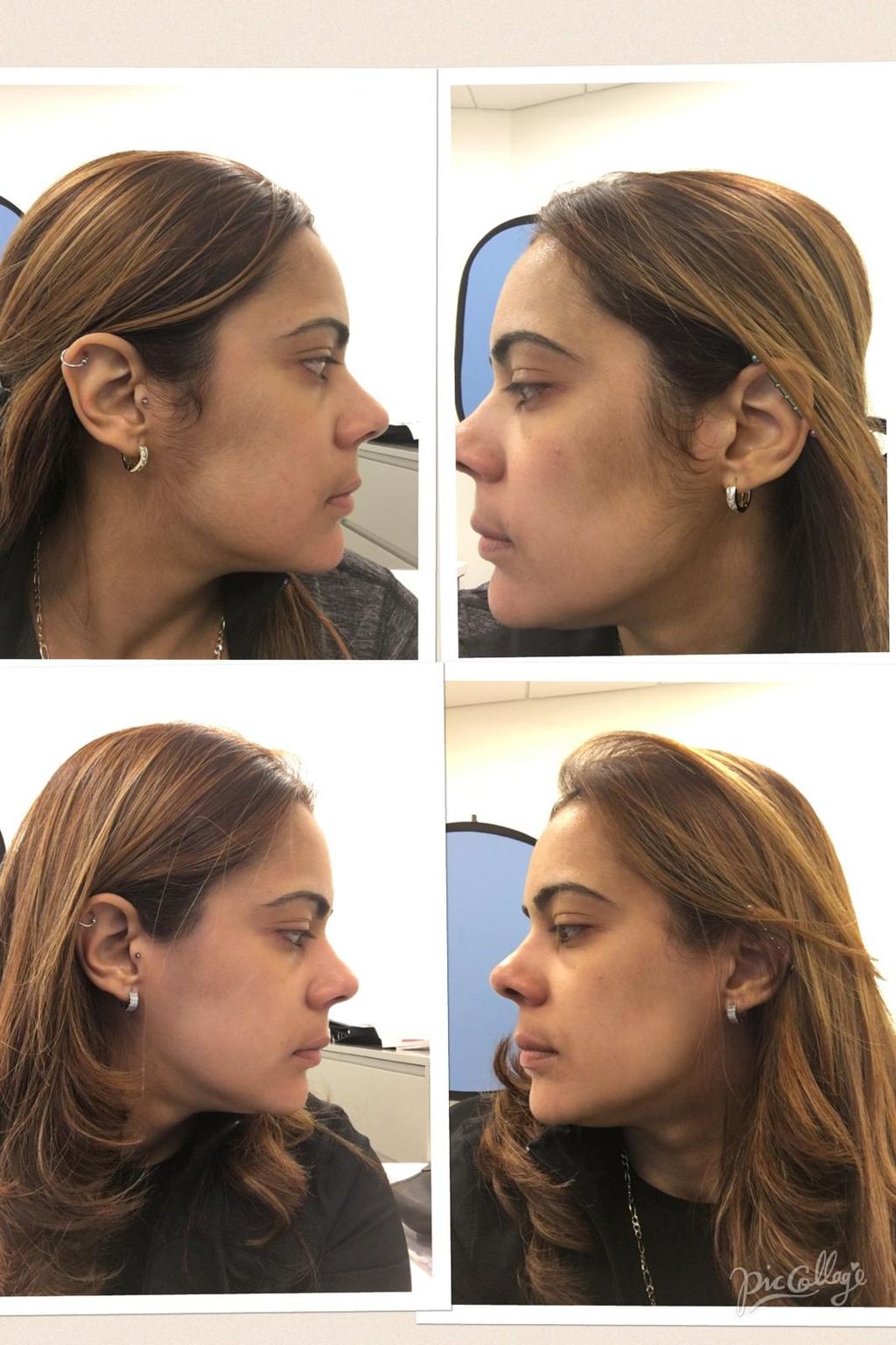 Laser Hair Removal Sideburns 
