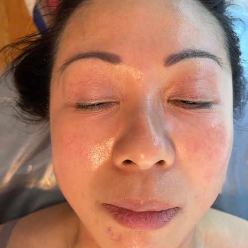 After Microdermabrasion Hydra Facial 