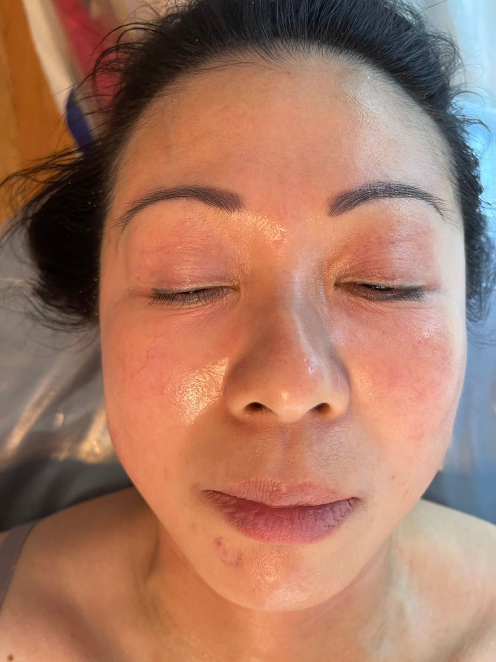 After Microdermabrasion Hydra Facial 