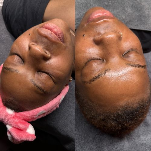 Facial Treatments